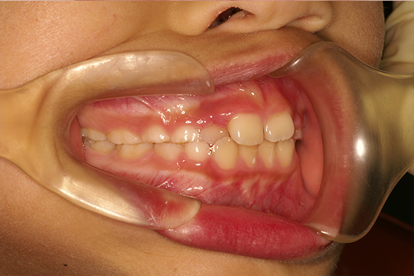 8歳女の子 出っ歯とでこぼこが気になる 立川の矯正歯科なら山下矯正歯科 抜かない矯正科